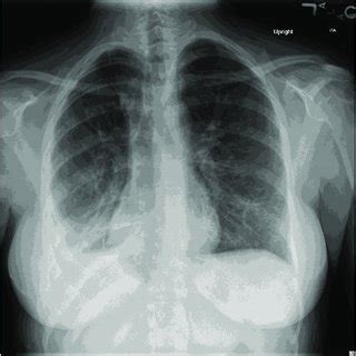 One Month Follow Up Chest Xray Following Discharge From The Hospital