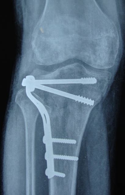 Xray Pictures Of Fractured Tibia Bone And Spine