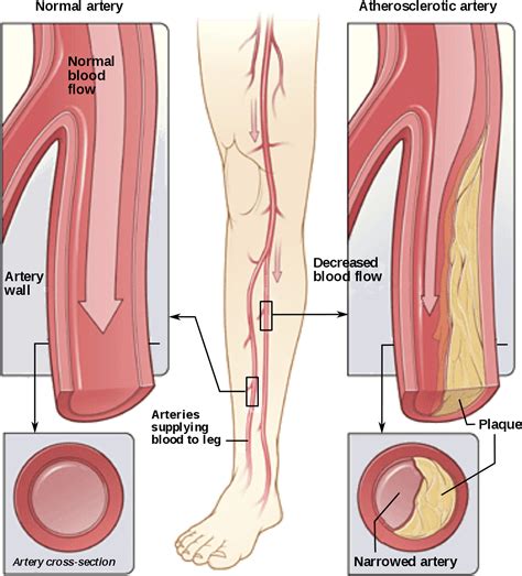 Download Peripheral Arterial Disease Peripheral Arterial Disease Diagram Clipartkey