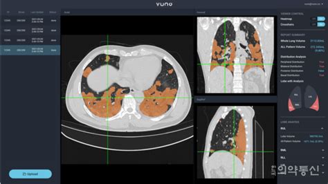 뷰노 호흡기 감염병 판단 도와주는 폐 Ct 분석 Ai 솔루션 인증 획득