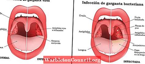 Os Tipos De Amigdalite Causas Sintomas E Tratamento M Dico