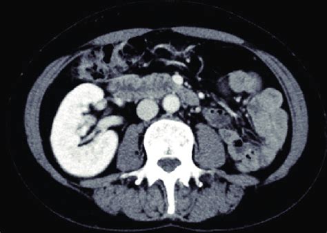 Ct Scan Shows The Absence Of The Left Kidney Ct Computed Tomography