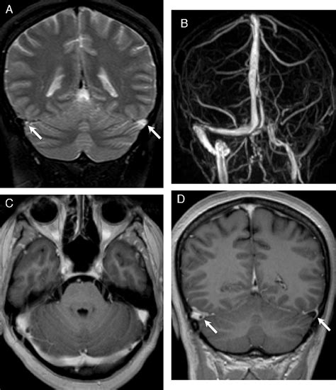 Transverse Sinus Mri