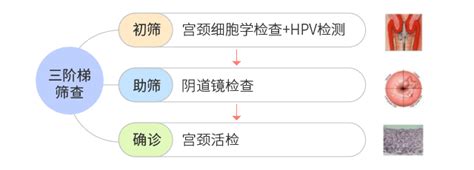 宫颈癌及癌前病变的诊断 知乎