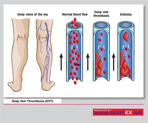 Deep Vein Thrombosis Statpearls Ncbi Bookshelf