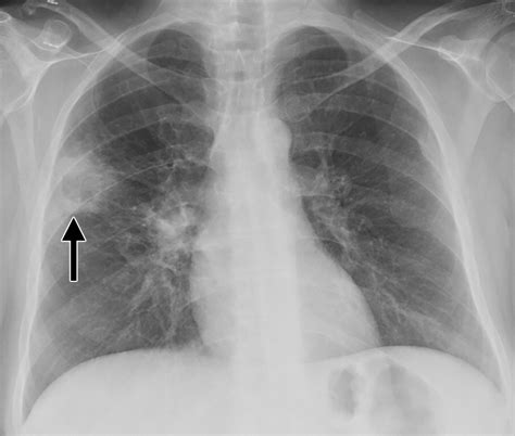 Pulmonary Coccidioidomycosis Pictorial Review Of Chest Radiographic And Ct Findings Radiographics