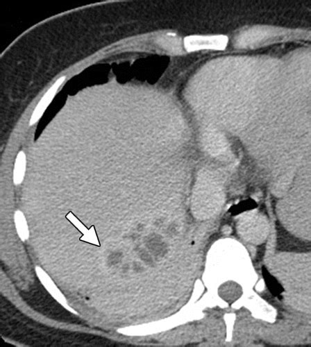 multimodality imaging  liver infections differential diagnosis