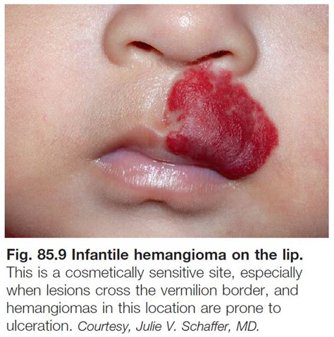 Superficial Infantile Hemangioma