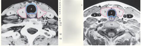 Neck Axial Ct Diagram Quizlet