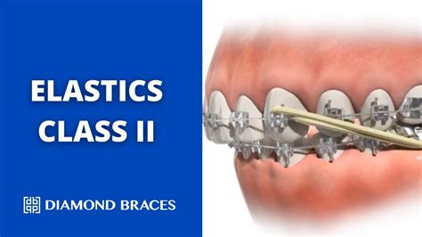 Elastics Class Ii Visual Guide To Function And Results Youtube