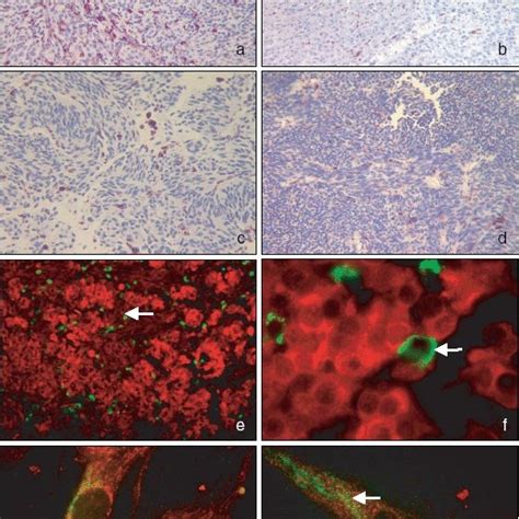 Photographs Of Uveal Melanoma Sections And Cultured Cells To Illustrate