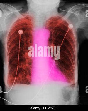 Röntgen Thorax zeigt COPD chronisch obstruktive Lungenerkrankung und