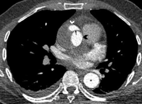 Axial Ct Aortogram The Ascending Aorta Circled Is Dilated And