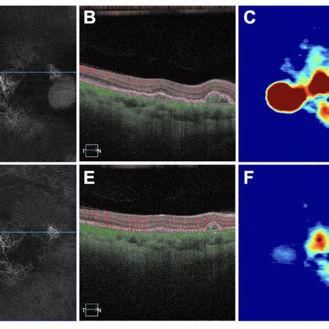 Mct And Cvi Measurements In Eyes With And Without Macular Fluid Before