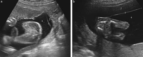 Chorioamniotic Membrane Separation After Fetoscopy In Monochorionic