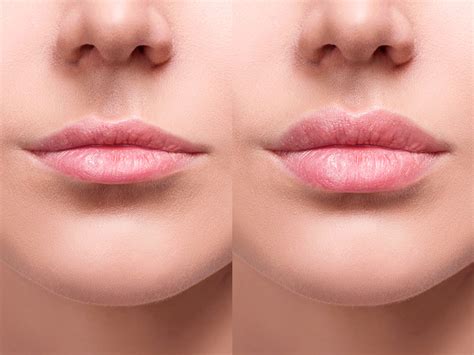 Preenchimento Labial Como Feito Valor E Resultados Dream