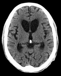 Huntington Disease - Neurology - Medbullets Step 1