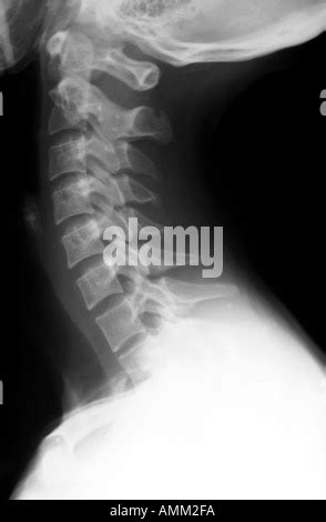 Normal cervical spine x ray - tolfhip