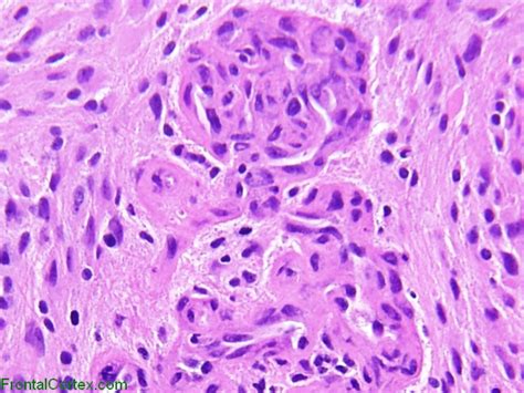 Glioblastoma Multiforme Microvascular Proliferation H E Stain X