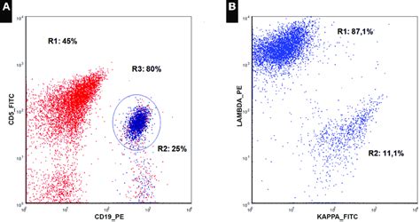 Flow Cytometry Of Mantle Cell Lymphoma In The Peripheral Blood