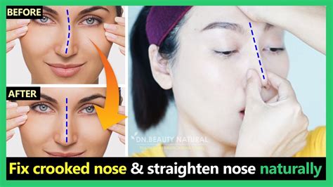 Fix Crooked Nose Uneven Nose Tip Deviated Nose Straighten Nose