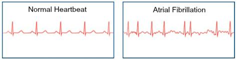 Can I Qualify For Life Insurance With Paroxysmal Atrial Fibrillation