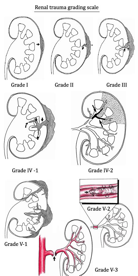 Simple Medicine Renal Trauma Grading Scale