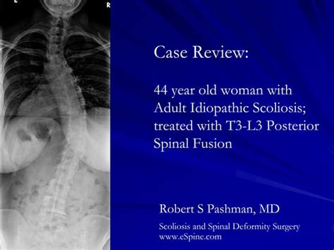 Case Review 34 44 Year Old Woman With Adult Idiopathic Scoliosis Ppt