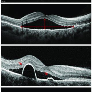 Representation Of The Optical Coherence Tomography OCT Variables