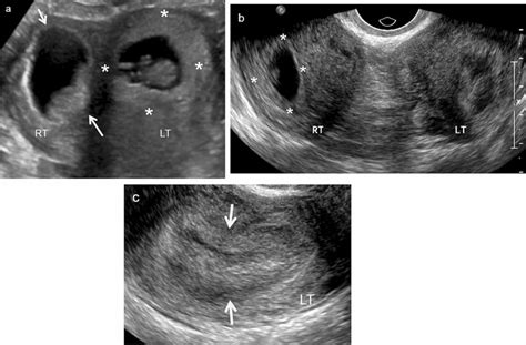 A 30 Year Old Woman With IUP In A Septate Uterus Transverse Ultrasound