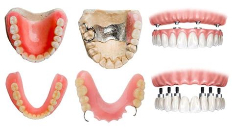 Tipos De Pr Tesis Dentales En El Salvador Dental King El Salvador