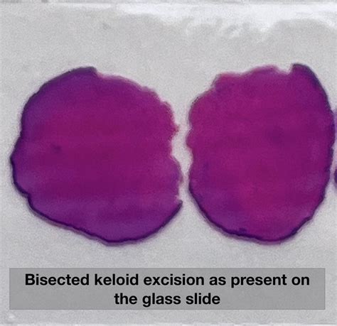 Histology Of Keloid Keloidal Scar An Abnormal Raised Reactive