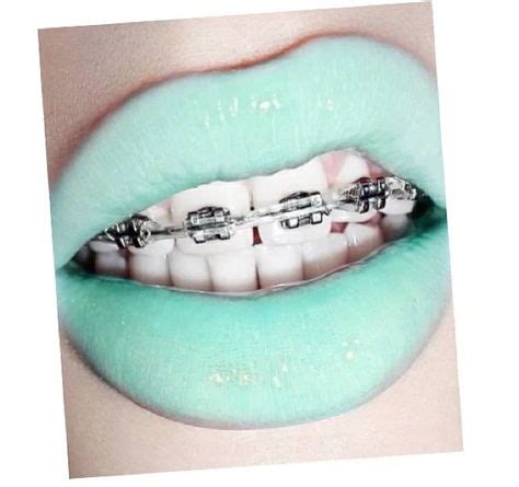 9 Best Braces images | Braces, Brace face, Braces colors