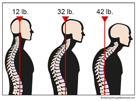 Forward Head Posture