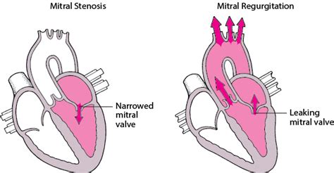 Overview of Heart Valve Disorders - Heart and Blood Vessel Disorders ...