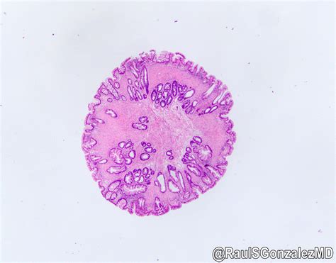 Pathology Outlines - Sessile serrated adenoma