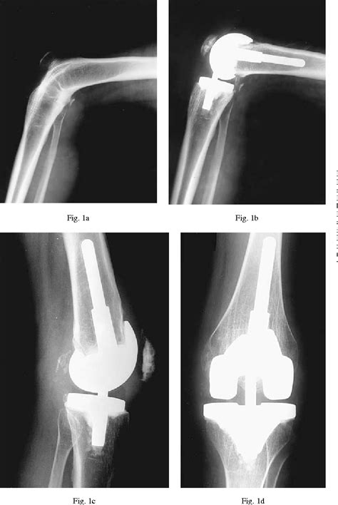 Figure From Total Knee Arthroplasty In Bony Ankylosis In Gross