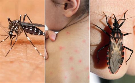 Dengue Chagas Y Sarampi N Los Brotes Silenciosos Noticias Unsam