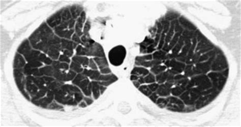 Pulmonary Edema CT Scan