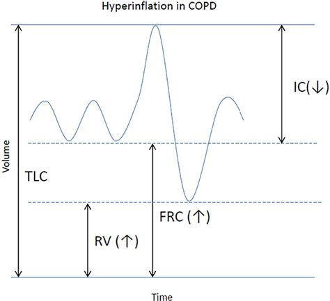 Schematic Volume Time Curve Showing Change In Lung Volumes In