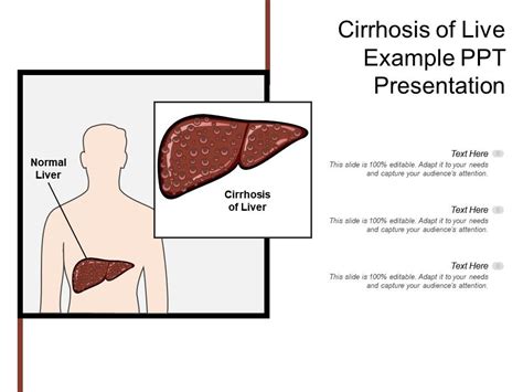 Cirrhosis Of Live Example Ppt Presentation Powerpoint Templates Download Ppt Background