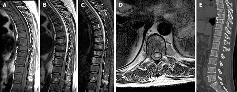 Extraosseous Spinal Epidural Plasmocytoma Associated With Multiple