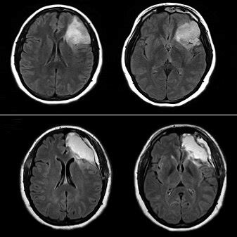 A Caso Representativo Rm De Cerebro Preoperatoria Secuencia