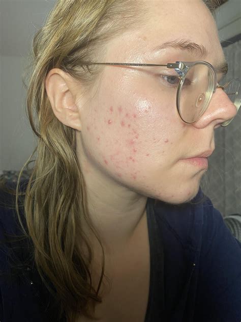 [Acne] Small bumps all over face : r/acne