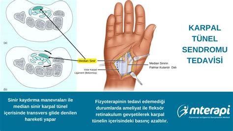 Karpal Tünel Sendromu Nedir Ameliyatsız Tedavi M Terapi