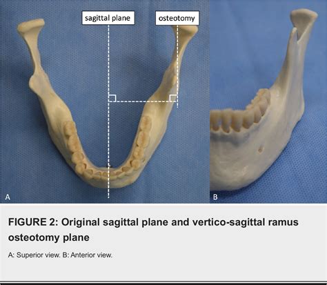 Figure 1 From A Comparative Review Of Mandibular Orthognathic Surgeries With A Focus On