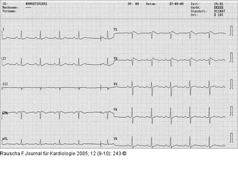 Abbildung 1 Brugada Syndrom