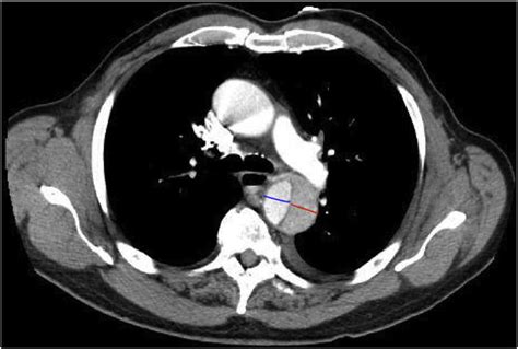 Aortic Dissection Ct Scan