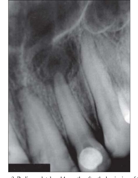 Periapical Granuloma Vs Cyst