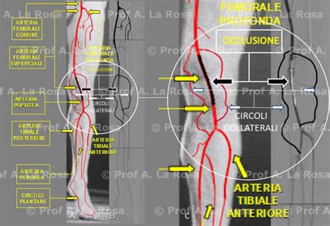 Ischemia Critica Degli Arti Inferiori Diagnosi E Cura Prof A La Rosa